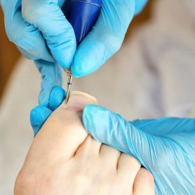 tìm hiểu lấy khóa móng chân