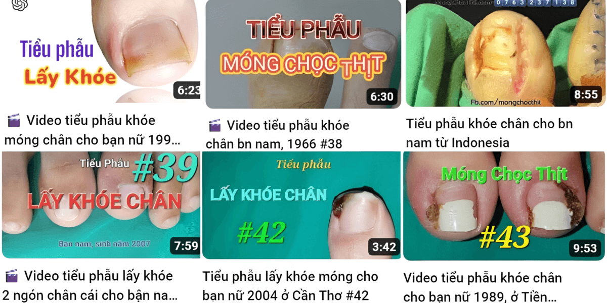 Laykhoemongchan.com có kinh nghiệm phẫu thuật nhiều ca móng chọc thịt khó