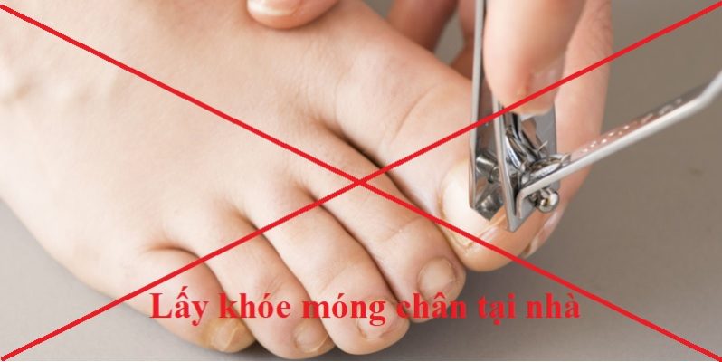 Có nên lấy khóe móng chân tại nhà? Dụng cụ tự lấy khóe có hữu dụng?