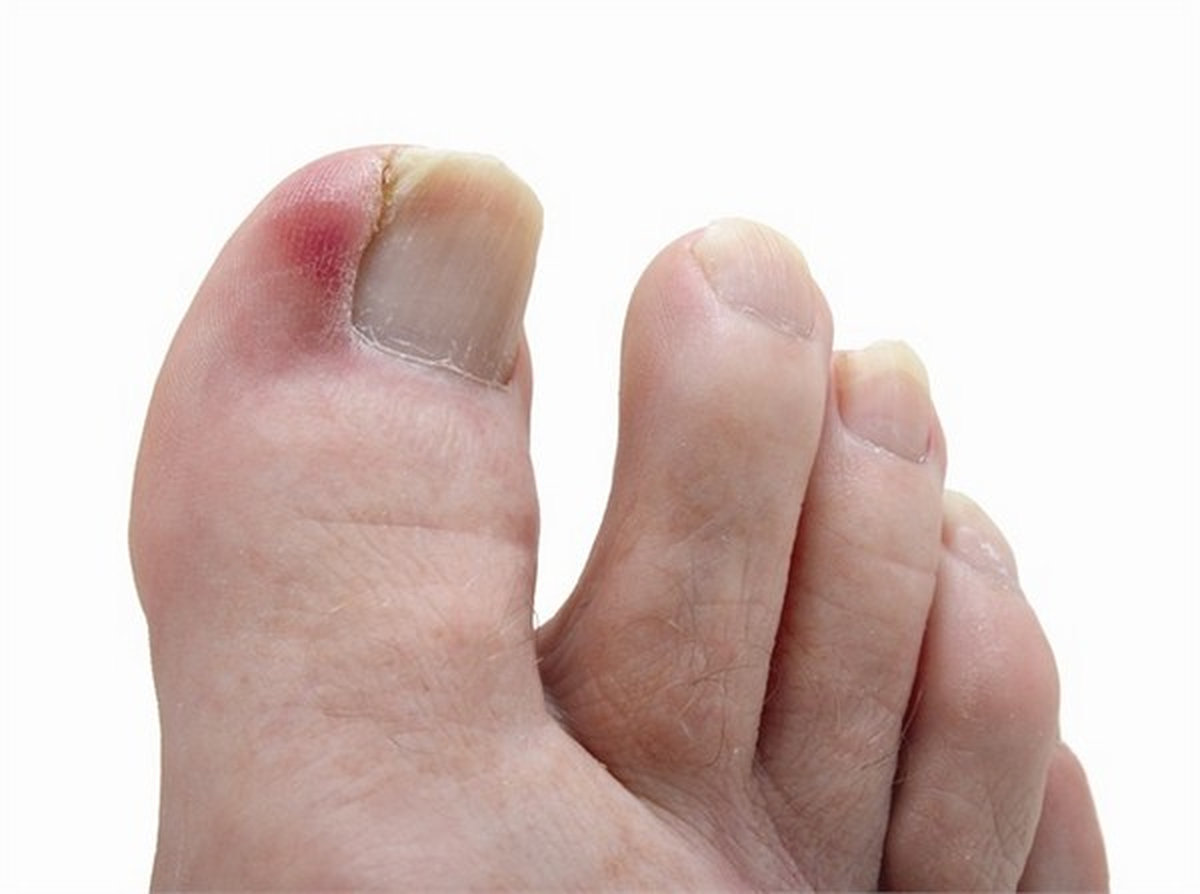 Biểu hiện của bệnh Chín mé
