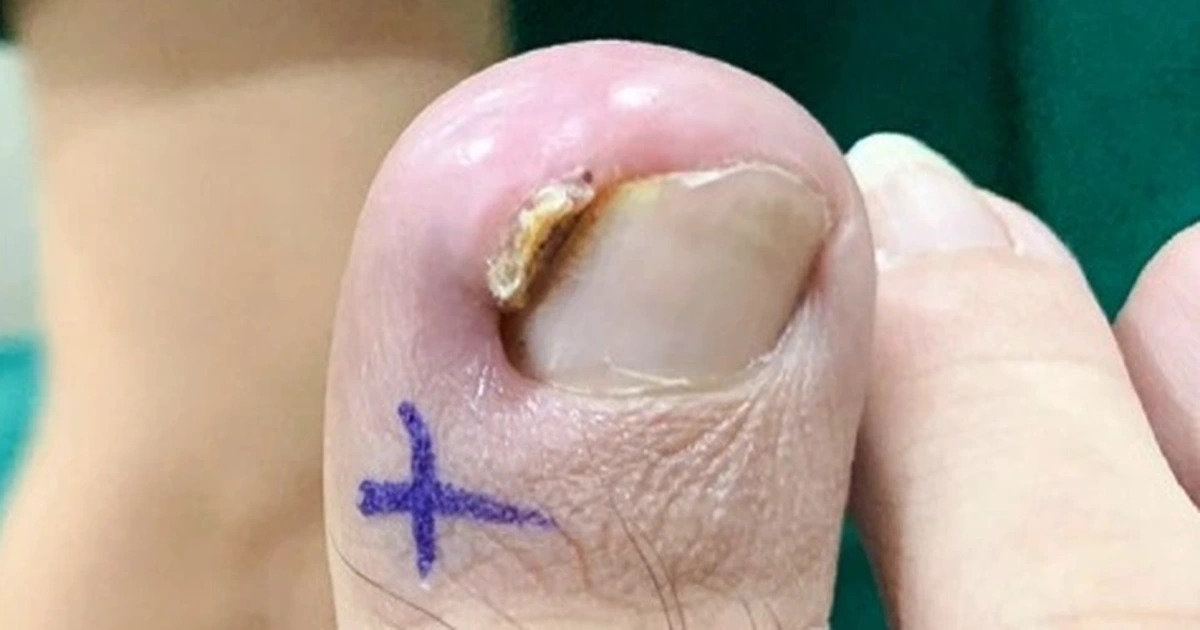 Triệu chứng của móng chọc thịt