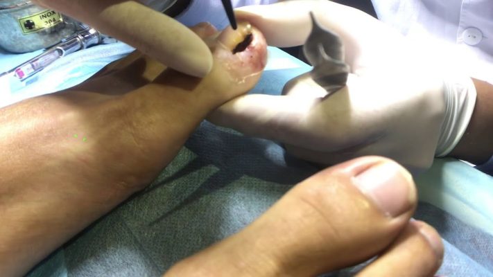Đốt laze móng chọc thịt mang lại hiệu quả tốt