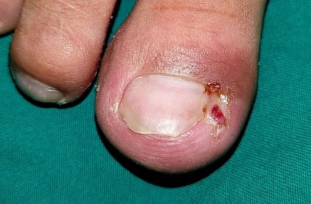 Hình ảnh móng chọc thịt chín mé và viêm khóe móng chân
