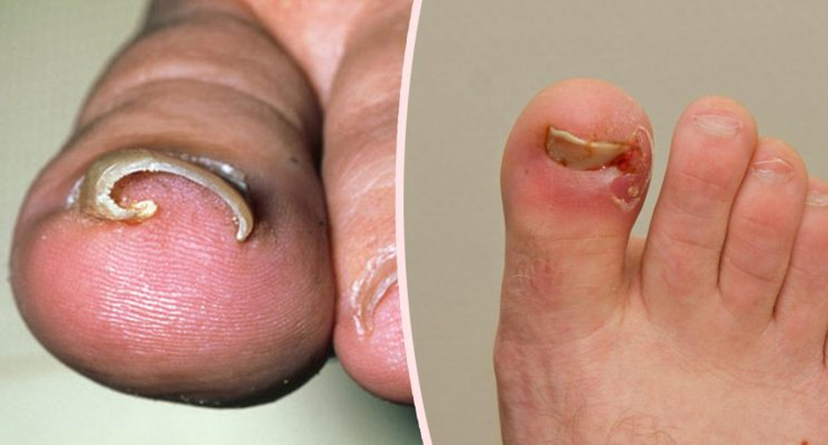 Móng chọc thịt không mọc thẳng mà quặp lại như móng vuốt