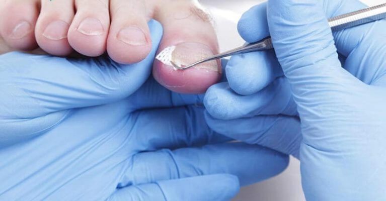 Phẫu thuật móng chọc thịt chữa trị bệnh dứt điểm