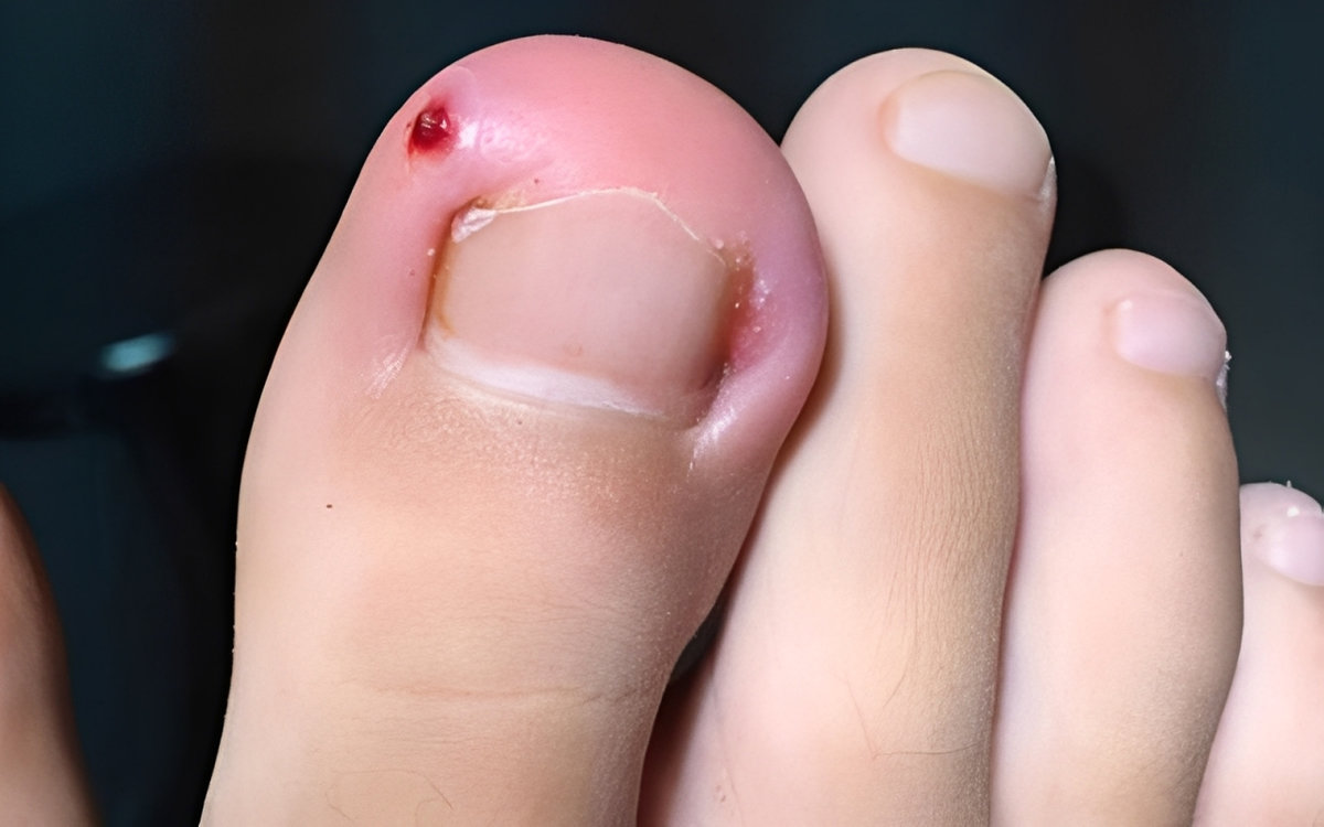 Khóe móng chân bị sưng viêm