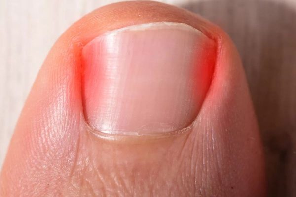 Cách trị sưng khóe móng chân tại nhà nhanh chóng, siêu dễ