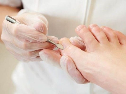 Hình ảnh cây lấy khóe móng chân