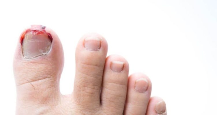 Coi lấy khóe móng chân đúng cách