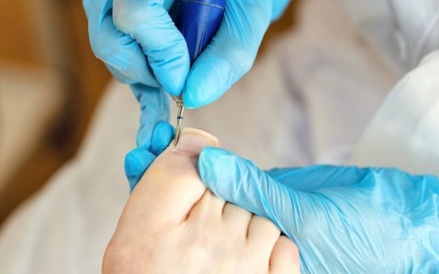 Chi phí lấy khóe móng chân bao nhiêu tiền mới an toàn