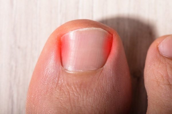 Cách lấy khóe móng chân có mủ an toàn và hiệu quả