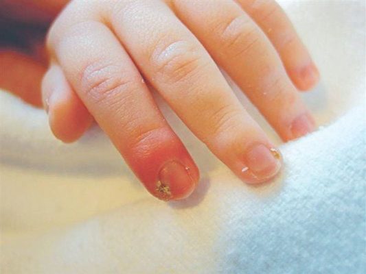 Cách lấy khóe móng tay bị sưng an toàn