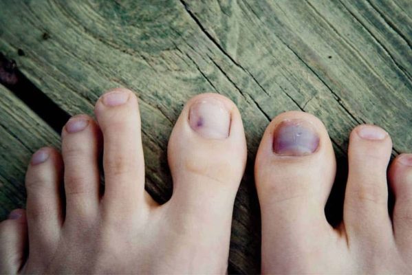 Cách xử lý khóe móng chân bị hư