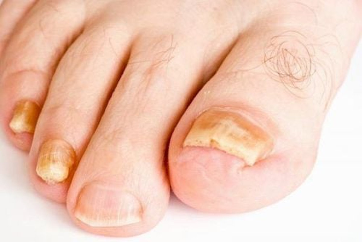 Khóe móng chân bị thối là xảy ra do sự xâm nhập của nấm