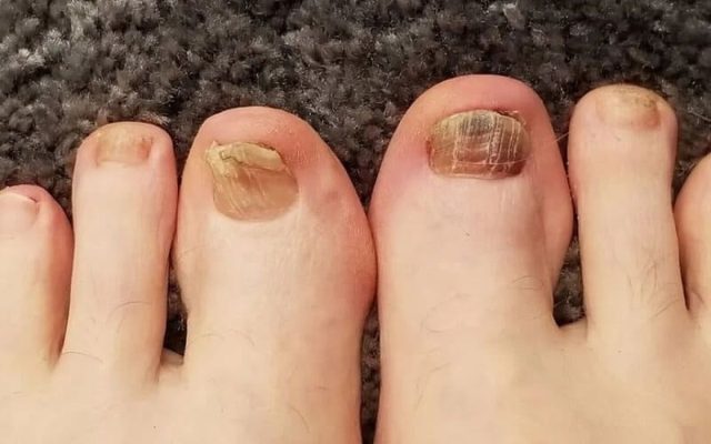 Hướng dẫn xử lý khóe móng chân bị thối tại nhà