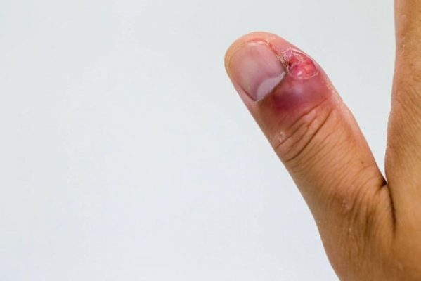Chăm sóc khóe móng tay bị hở an toàn, hiệu quả