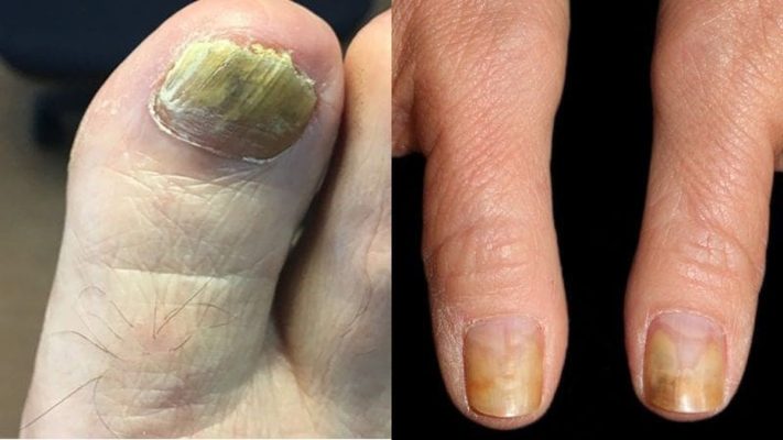 Top 6 loại thuốc trị thối khóe móng chân hiệu quả vượt trội