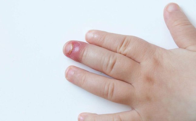 Cách chữa đau khóe móng tay hay chín mẹ tại nhà hiệu quả