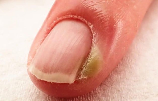 Khóe móng tay nói gì về sức khỏe?