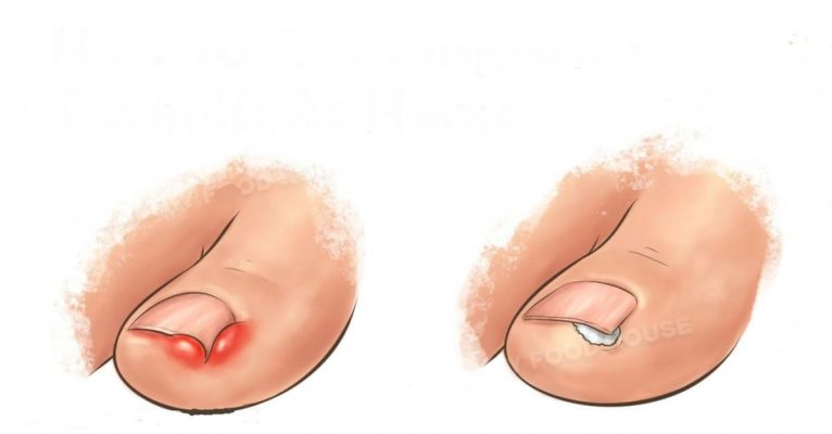 Các phương pháp phẫu thuật móng chọc thịt