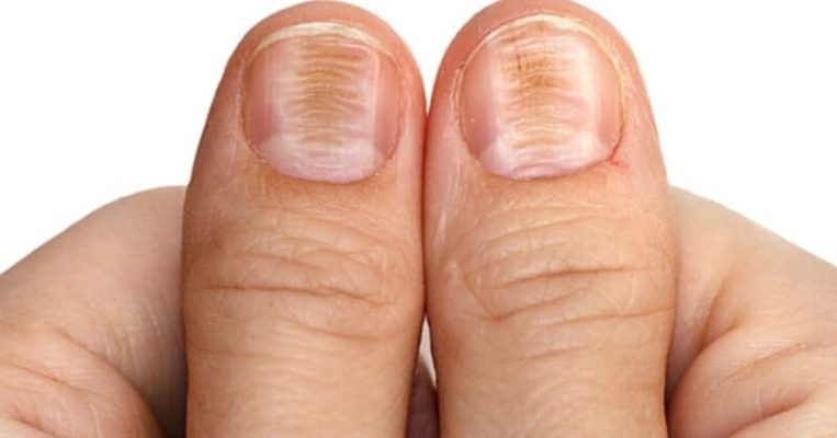 Viêm khóe móng tay ở trẻ có nguy hiểm không?