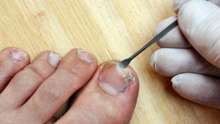 Cách khắc phục khóe móng chân tại nhà an toàn