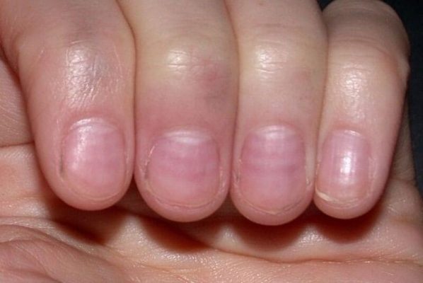 Cách lấy khóe da hiệu quả và không đau