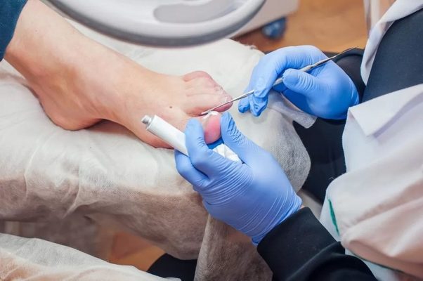 Cần lưu ý gì sau khi tiểu phẫu móng chọc thịt?