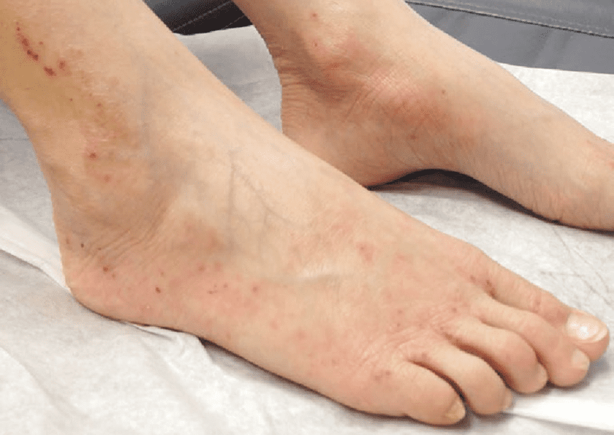 Viêm da có thể khóe móng chân mưng mủ