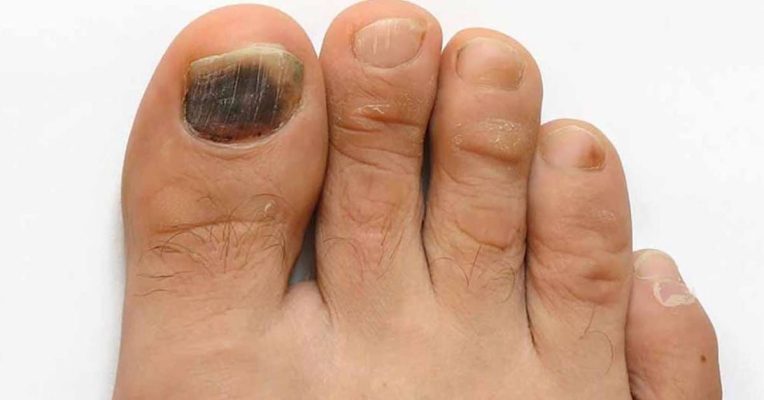 Cách chăm sóc móng chân bị hư hiệu quả