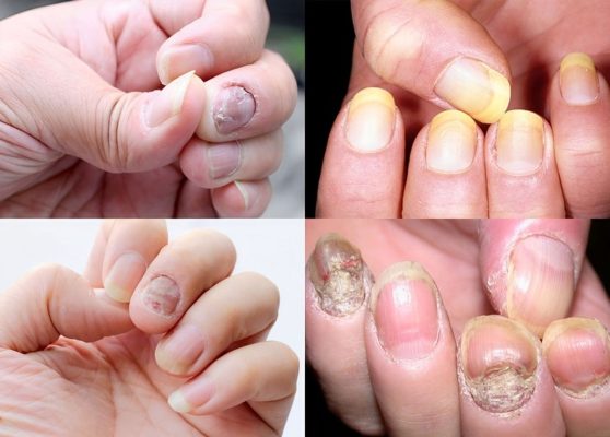 Bí quyết chăm sóc móng tay bị hư tổn