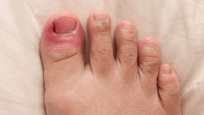 Nguyên nhân gây mưng mủ khóe móng chân sau sinh