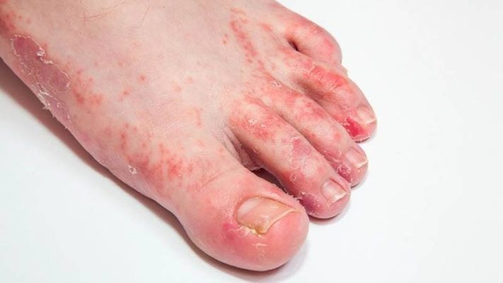 Cách điều trị nước ăn tay chân hiệu quả