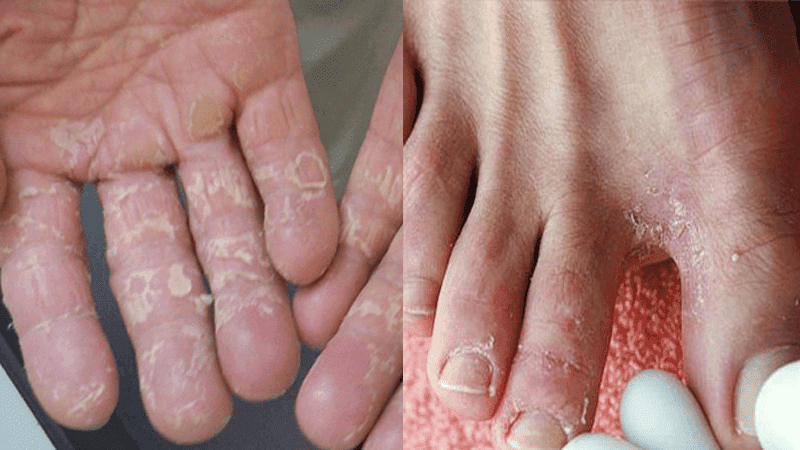 Tình trạng này xuất hiện nhiều nhất và thường bắt nguồn từ nấm dermatophytes