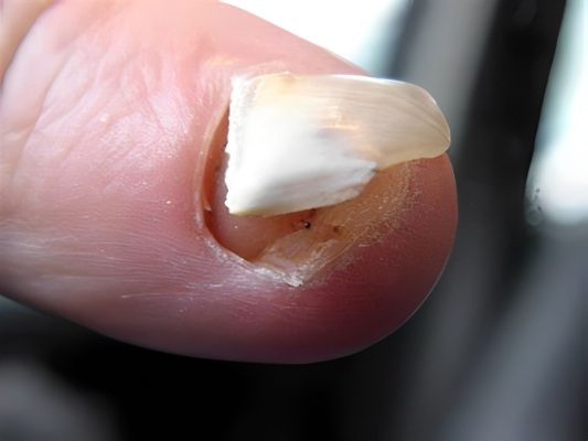 Hướng dẫn cách chăm sóc móng chân bị bật