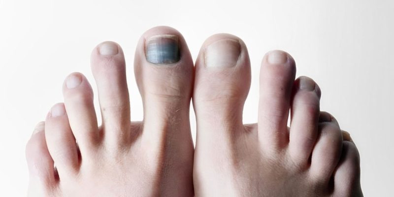 Cách sơ cứu dập móng đúng cách