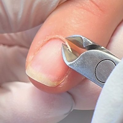 Các bệnh về móng chân thường gặp nhất