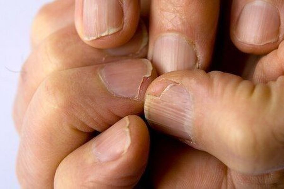Đây là tình trạng móng bị tổn thương do các yếu tố vật lý bên ngoài tác động
