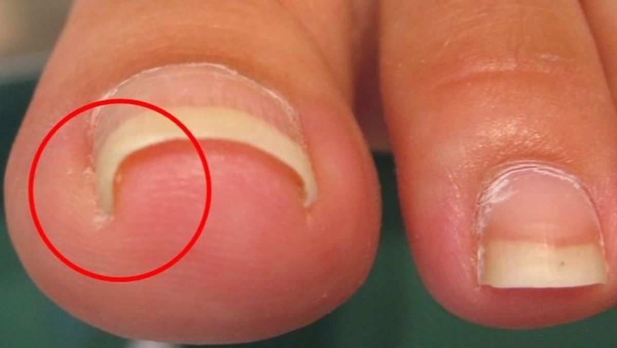 Tình trạng móng bị tách lớp thường xảy ra khi móng phải tiếp xúc quá nhiều với hóa chất