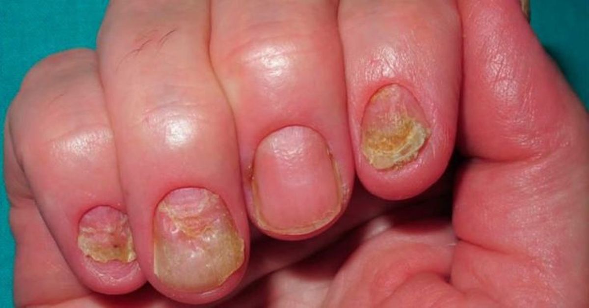 Trên bề mặt móng tay xuất hiện những lỗ nhỏ như bị kim châm