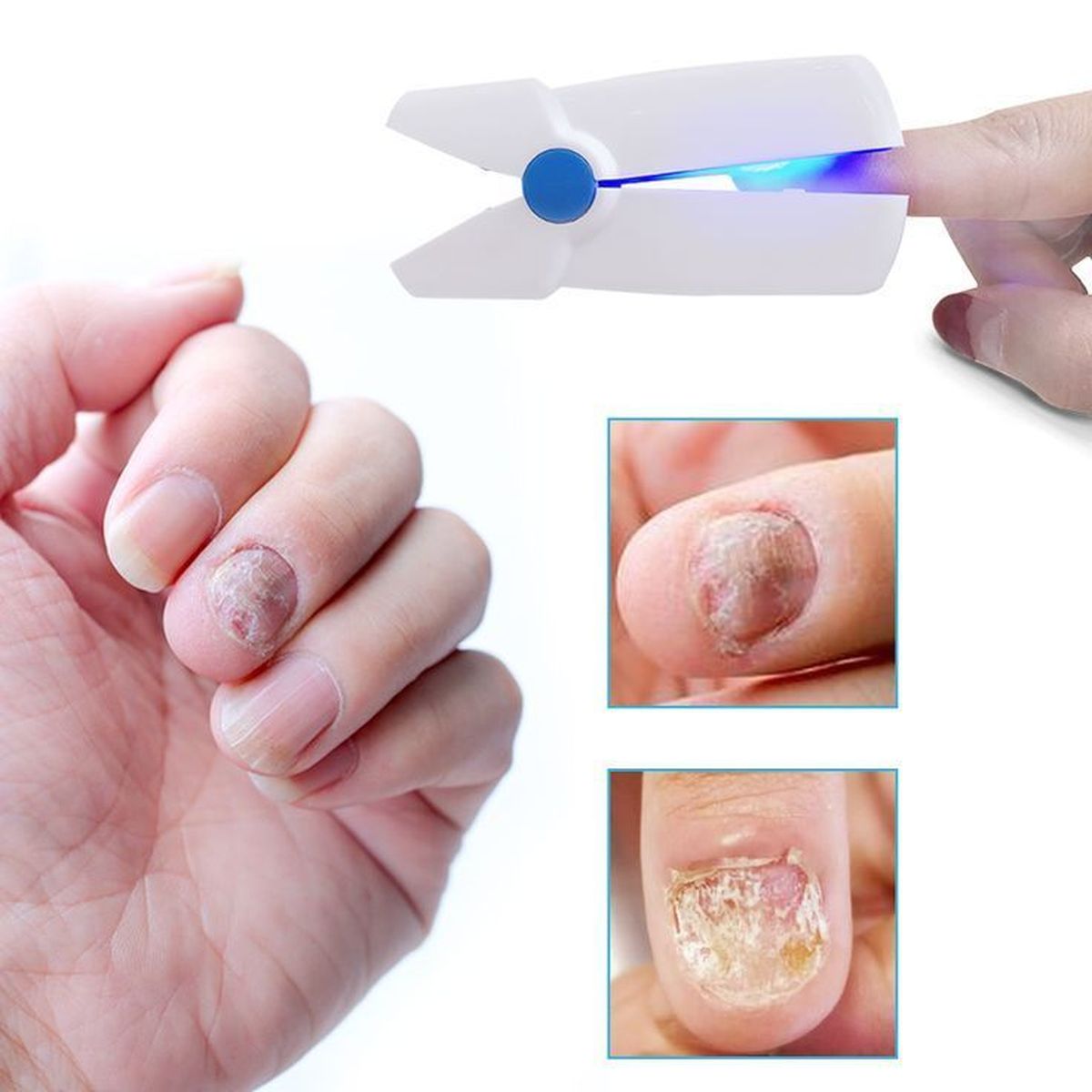 Candida là loại nấm thường xuất hiện ở những người có thói quen tiếp xúc với nước trong thời gian dài.