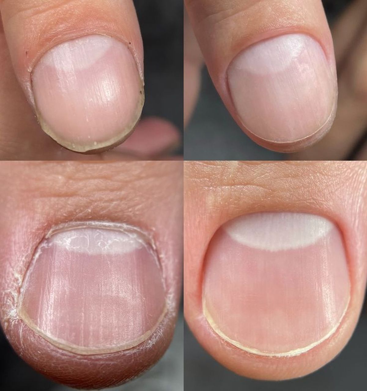 Nứt và xước quanh móng tay là tình trạng da xung quanh móng bị bong tróc