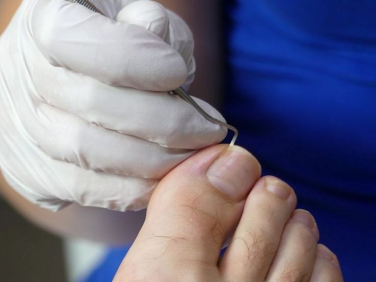 Khi móng chân bị tổn thương nặng và không thuyên giảm dù đã chăm sóc tại nhà, bạn cần chủ động đến cơ sở y tế