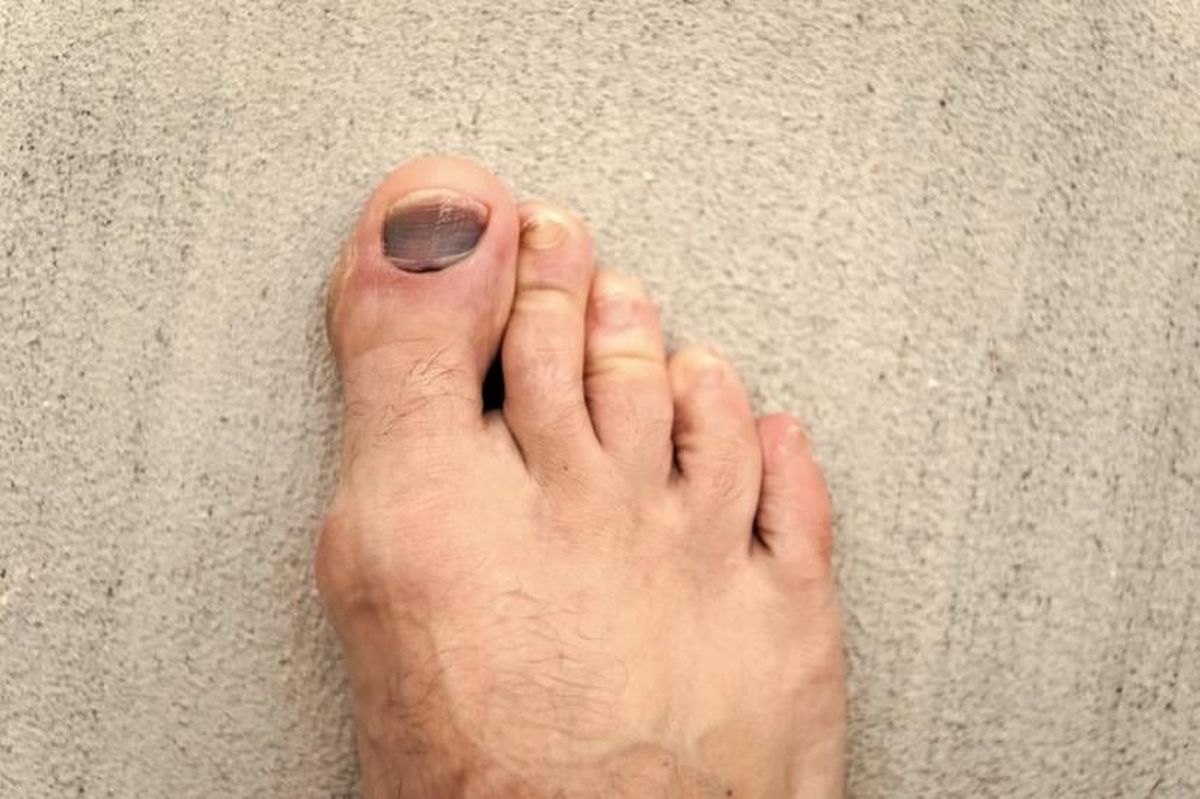 Móng chân bị tím thường gây cảm giác đau nhức và khá khó chịu