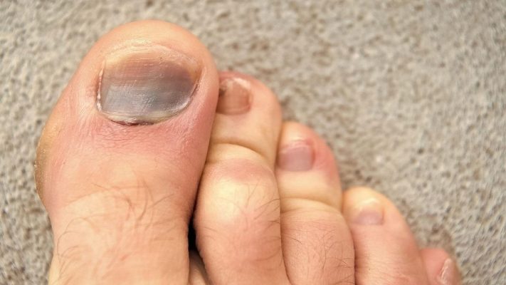 Nguyên nhân móng chân bị tím