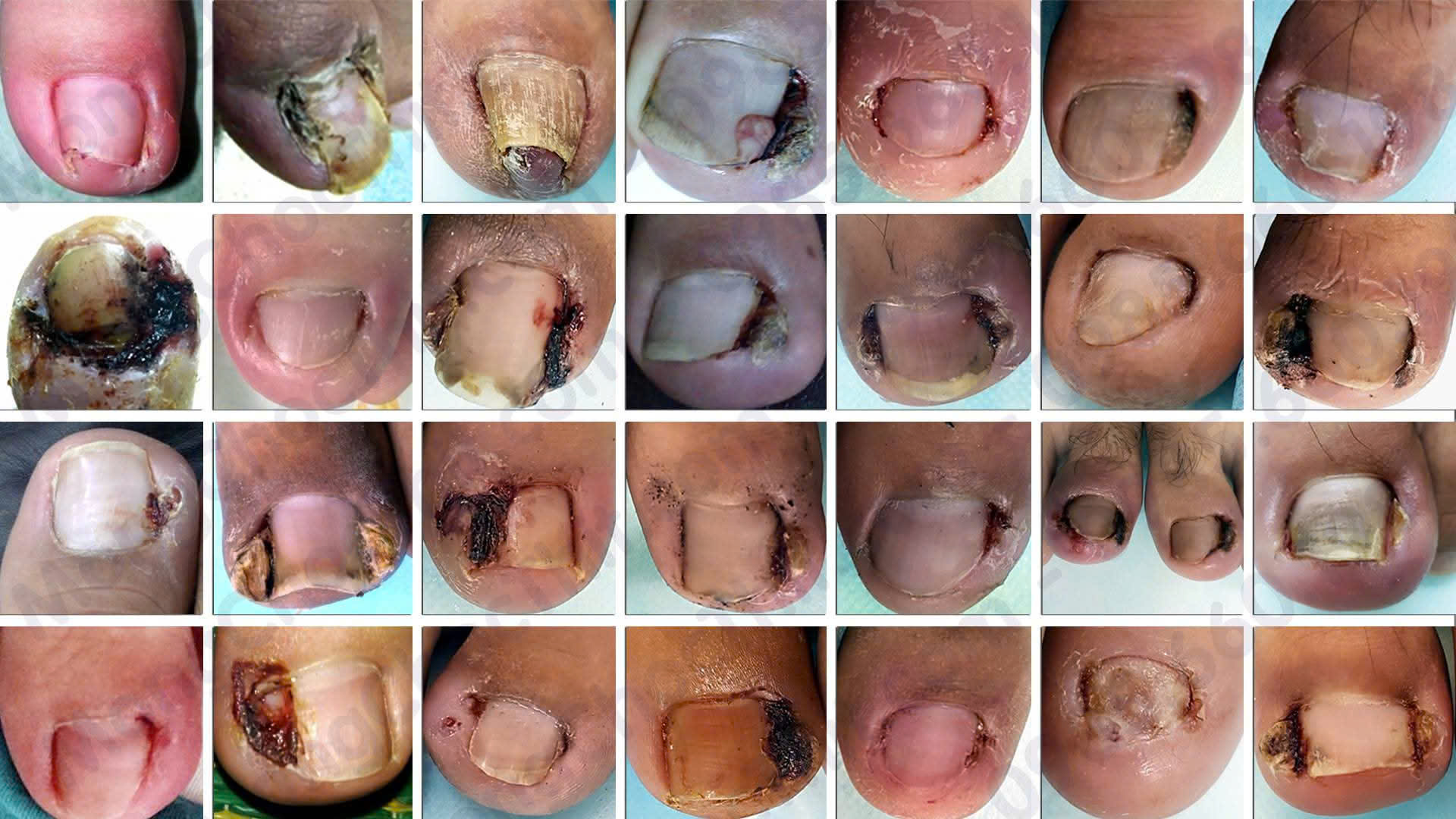 Nhiều phương pháp lấy khóe móng chân không đúng cách làm bệnh trở nên nghiêm trọng hơn